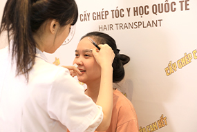 cấy ghép tóc tự thân