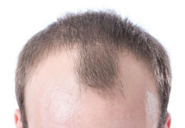 Những kiểu hói đầu thường gặp và cách điều trị hiệu quả