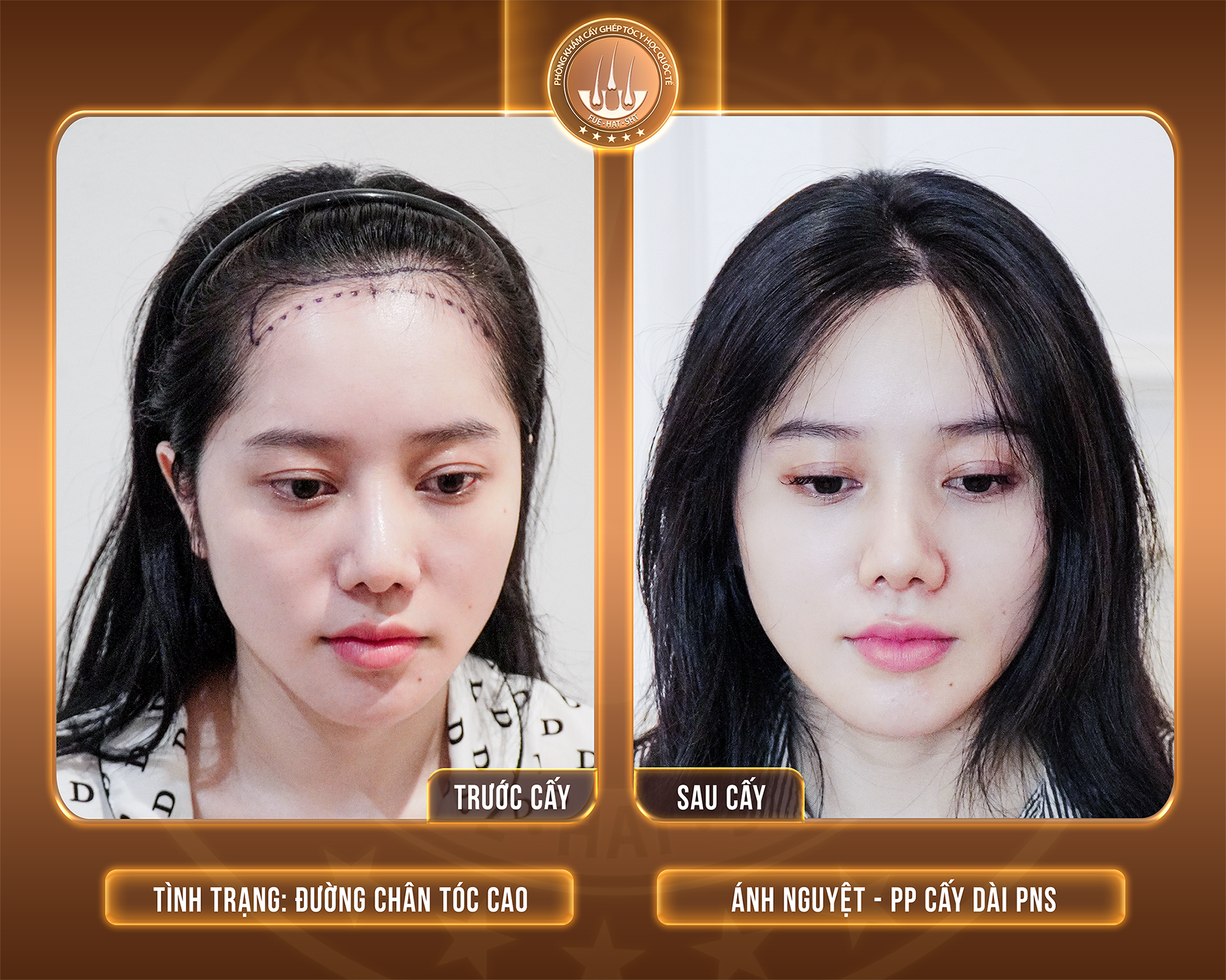 cấy ghép tóc tự thân