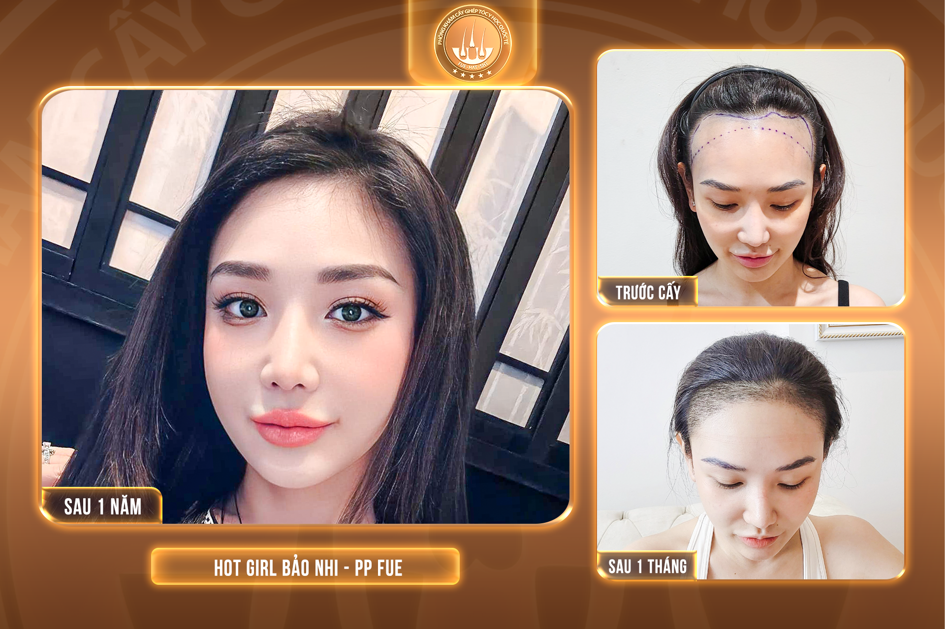cấy ghép tóc tự thân
