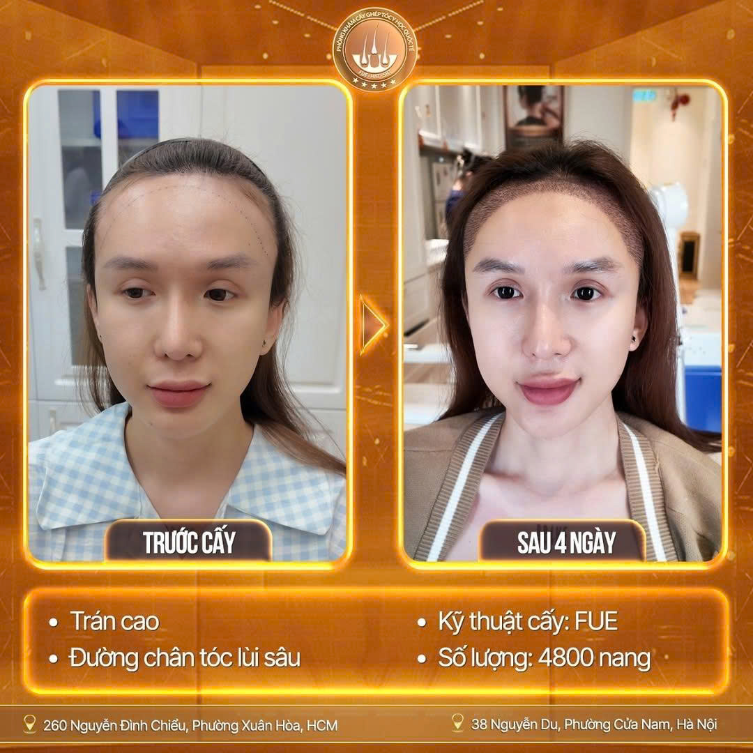 cấy ghép tóc tự thân