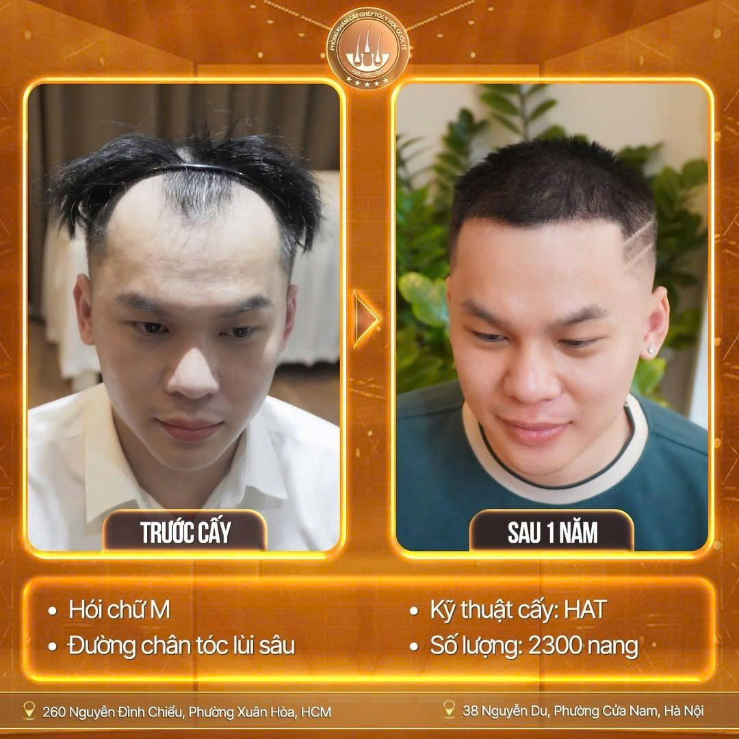 cấy ghép tóc tự thân