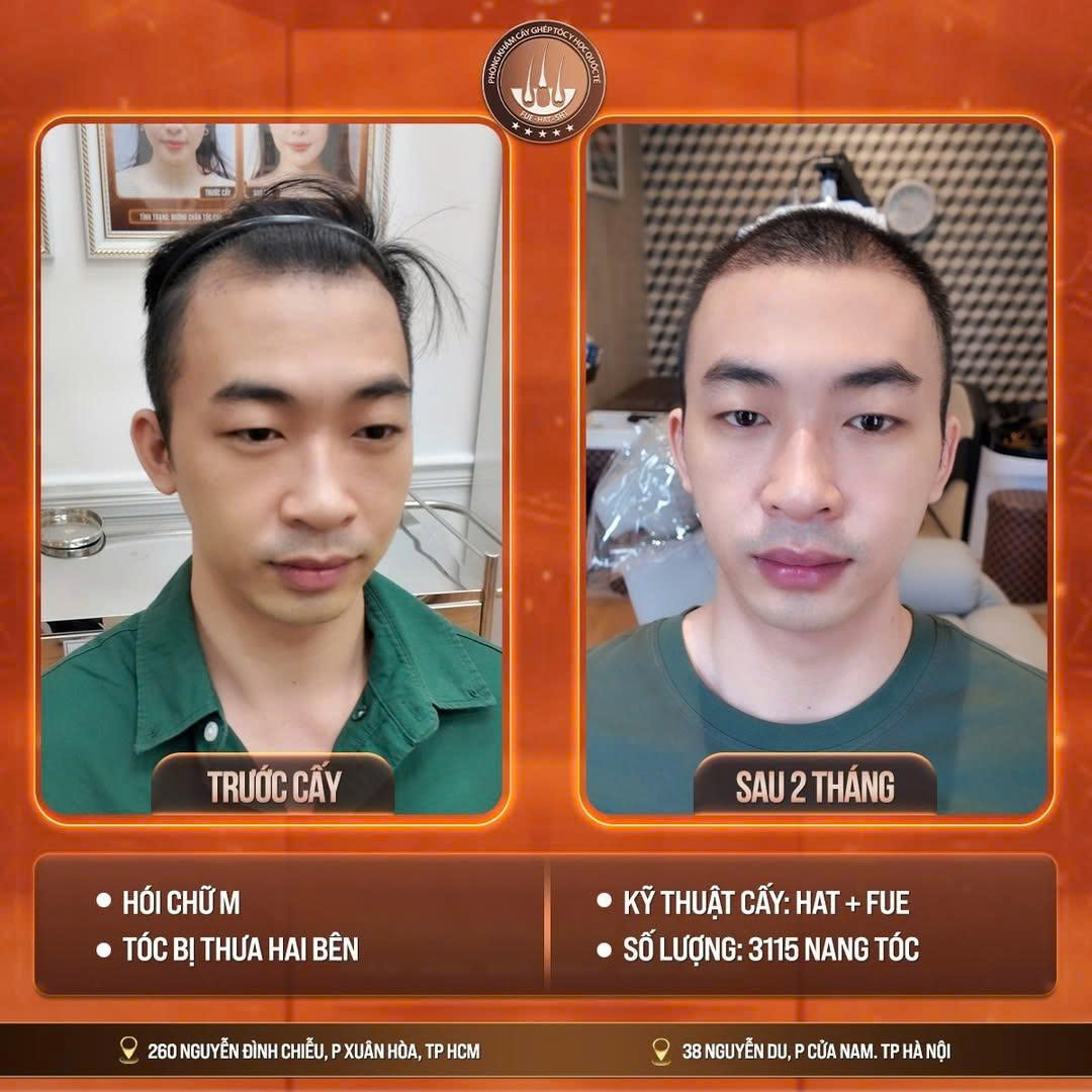 cấy ghép tóc tự thân